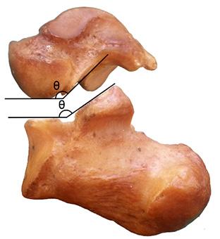 29 Kuva 18. Kantaluun ja telaluun välinen leikkauskulma (jung ym. 2015). Tarsaalikanaalin leveys (kuva 19) mitattiin kummastakin luurakenteesta ja mittausvälineenä käytettiin työntömittaa.