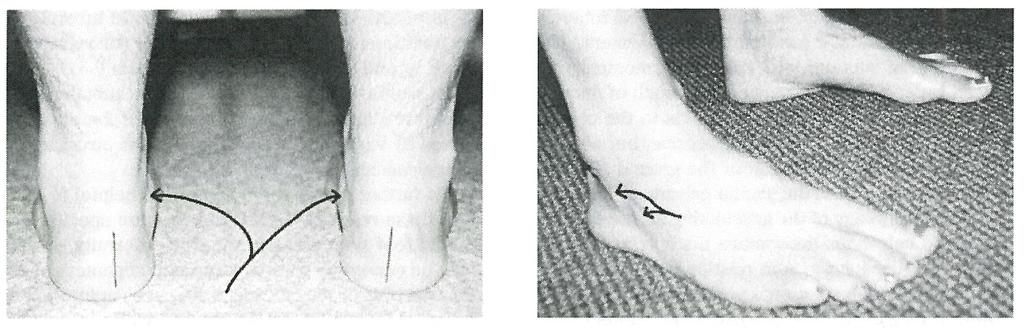 Eräs ilmiö, jota esiintyy tämän tyyppisissä jaloissa tutkittaessa seisonta-asentoa, on fibularis-lihasten jänteiden jännittyneisyys.