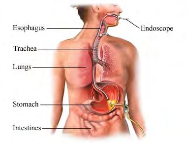 gastrostomia (PEG-letku) Taustalla oleva sairaus tai