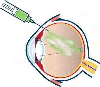 Hoito Diabeettista retinopatiaa ja makulaturvotusta voidaan hoitaa. Koska näkökyky voi heiketä hyvinkin nopeasti, on tärkeää käydä säännöllisissä näöntarkastuksissa ennen oireiden ilmaantumista.