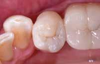 Lisäksi useiden sävyjen yhdistäminen on erittäin vaikeaa ja epäkäytännöllistä normaalissa työtilanteessa. Aura easyn avulla voit helposti luoda luonnollisen näköisiä hampaita.