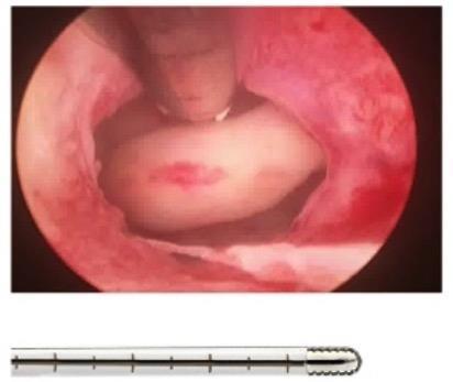 MORSELLAATTORIT 5 mm hysteroskooppi, 0 astetta 2,9 mm