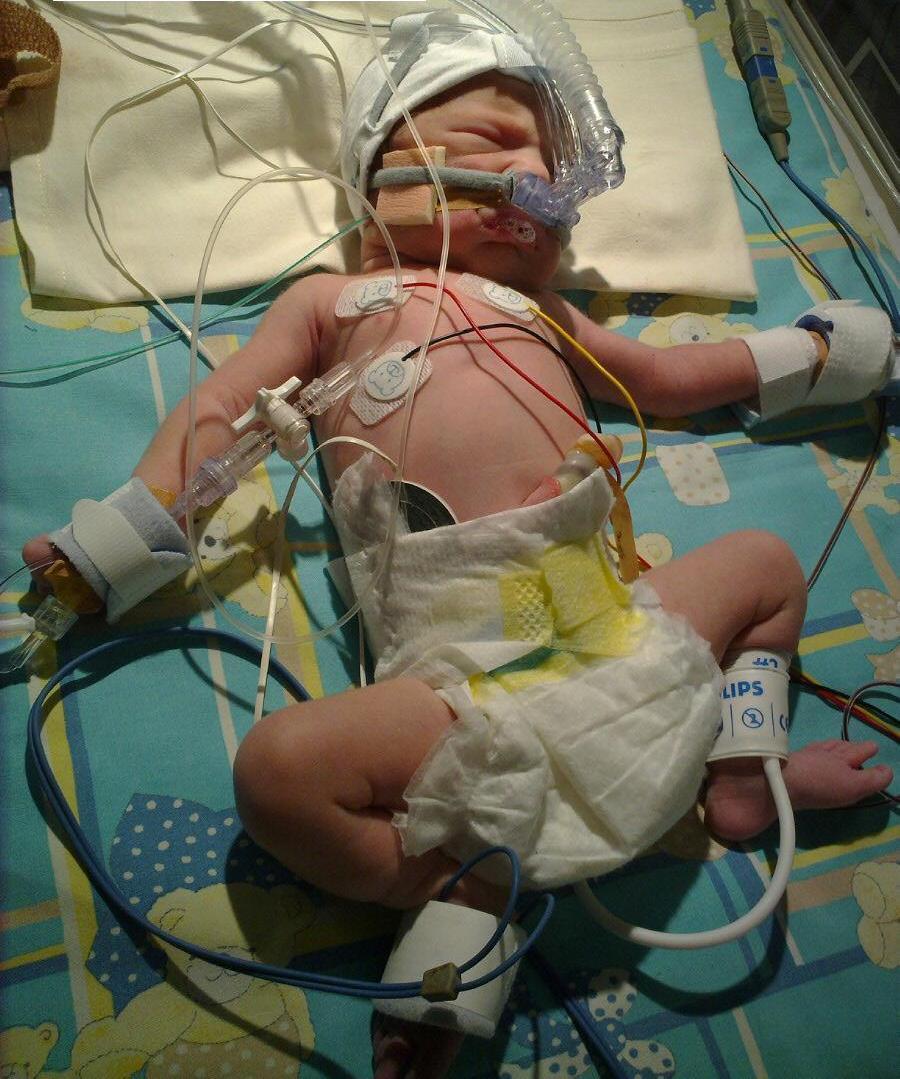 Apgar 1/3/4, A-pH 6.84, Be -19.4, V-pH 6.92, Be -16.8. Meconium Aspiration Syndrome.