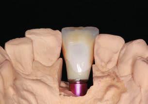 Jotta hammaslaboratoriossa valmistetut hampaat näyttäisivät aidoilta, tulee niissä olla luonnollisia sävyeroja.