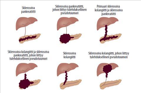 IgG4-kolangiitti Liittyy läheisesti autoimmuunipankreatiittiin Eroja primaariin sklerosoivaan kolangiittiin: Hyvä vaste glukokortikoideille