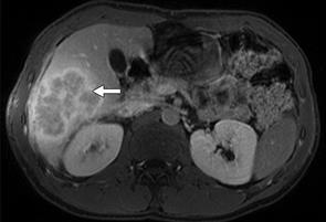 Muita IgG4-taudin intraabdominaalisia ilmentymiä Maksan