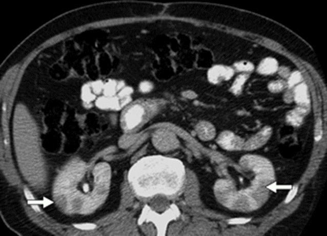 aneurysma Fibrotisoiva mesenteriitti Retroperitoneaalifibroosi ja