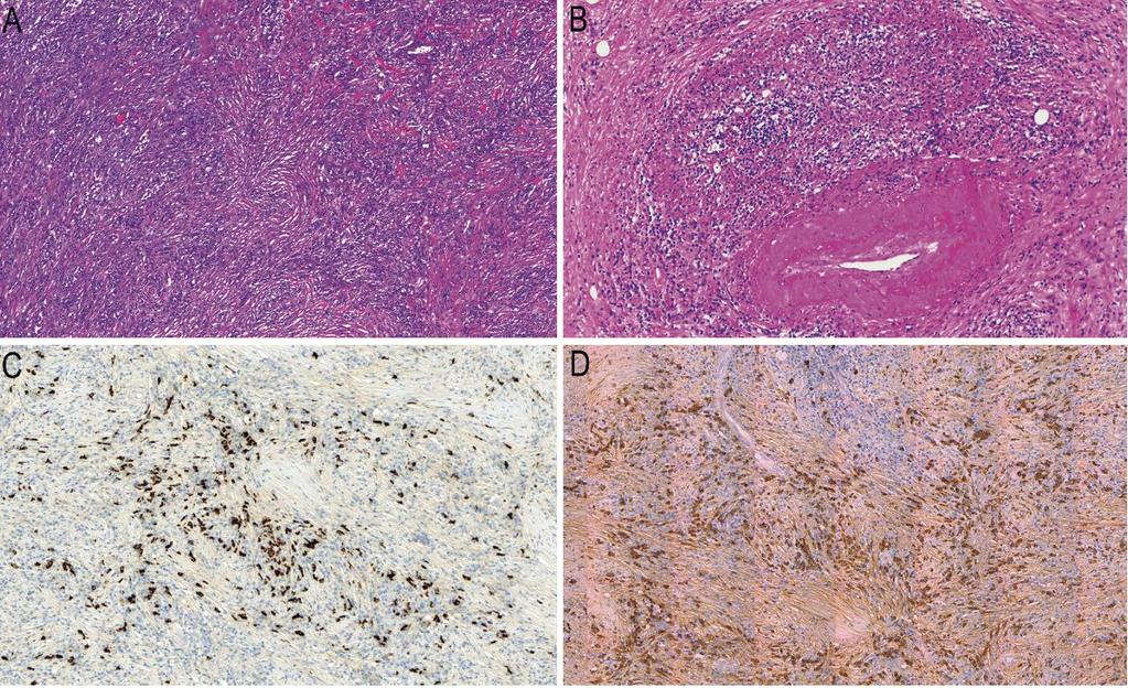 Soluinfiltraatio ja pyörteinen fibroosi Obliteratiivinen flebiitti IgG4-immunovärjäys IgG-immunovärjäys IgG4-related disease: