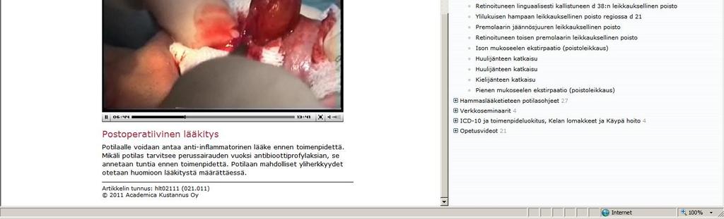 Juurakon poisto kokonaisena tai halkaistaan juuret vielä vertikaalisesti fissuuralla Hupp et al. 2008 Hupp et al.