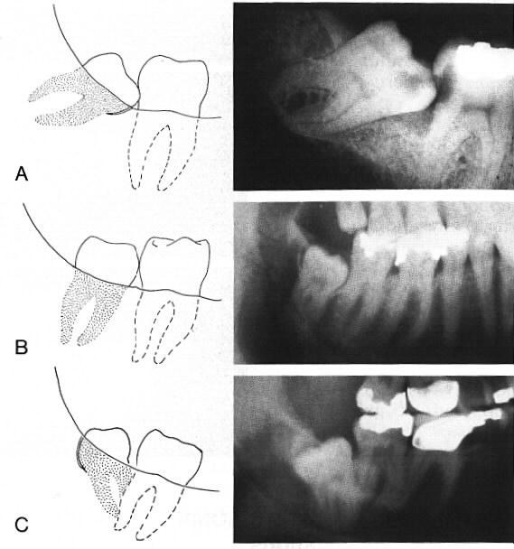 2003 26 Retinoituneen hampaan luokittelu kuvantaminen Syvyys leukaluussa: S=superficial M=medium D=deep Etu takasuunta: I=tilaa riittävästi II=ei