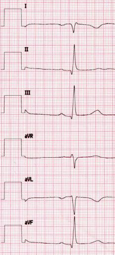 Normaali EKG Oikean ja vasemman yläraajan johtimen vaihtuminen