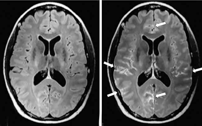 TEEMA: MAGNEETTIKUVAUS A B KUVA 1. Potilaan anamneesissa mainittiin levinnyt syöpä. Neurologisten oireiden vuoksi tehtiin pään mag neetti kuvaus.