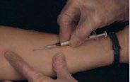 LIITE C: TUBERKULOOSIN TESTAUSOHJEET Mantoux-testi, tuberkuliini-ihokoe 1.