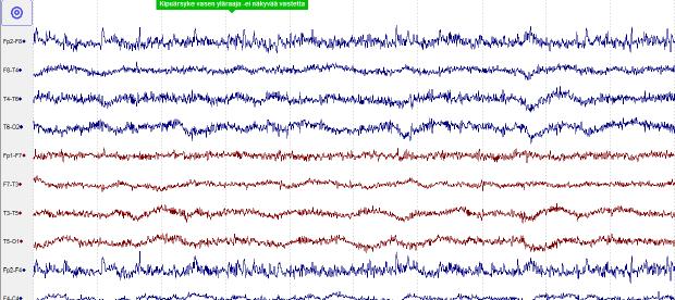 kuva 1. A. Ensimmäisessä EEG:ssä midatsolaami-, morfiini-infuusion sekä tiopentaalibolusten aikana vahva-asteinen yleishäiriö, ei reaktiivisuutta ärsykkeisiin. B.