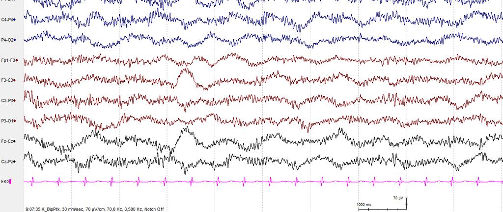 EEG:ssa kohtausta edelsi vaimeneminen ja korkea-amplitudinen deltatoiminta, joka tulkittiin aivoperäiseksi kohtaukseksi. Lapselle aloitettiin antikonvulsiivinen lääkitys (levetirasetaami).