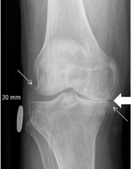 17 Tuite MJ, Kransdorf MJ, Beaman FD ym. ACR appropriateness criteria acute trauma to the knee. J Am Coll Radiol 2015;11:1164 72. 18 Mosher TJ, Kransdorf MJ, Adler R ym.