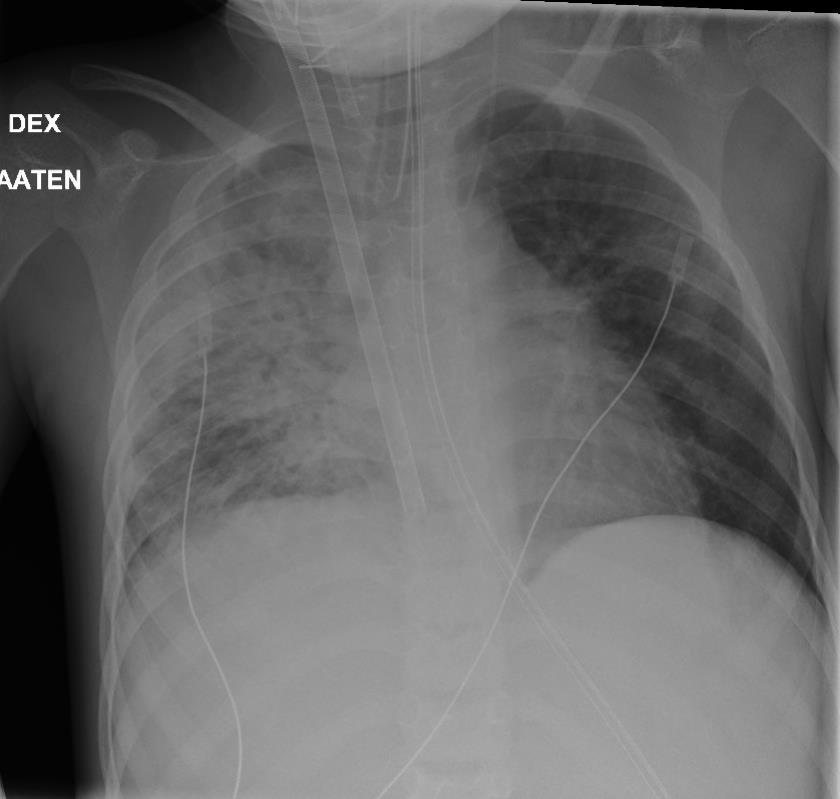 ECMO päättyy 27.2. Vancomysiini % 22.2. (yht. 9 vrk:tta) Levofloksasiini % 24.2. (yht. 6 vrk:tta) Meropeneemi % 2.3. (yht. 19 vrk:tta) 5.