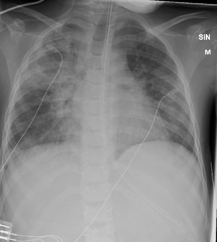 Takaisin Tamperreelle 6.3. Ekstubaatio 3.3. Flukonatsoli jatkuu siirtovaiheessa Yhteenveto: teholla 31.1.-6.3. (=5 viikkoa) intuboituna 31.1.-3.3. ECMO 8.2-