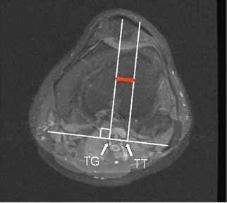 Kuva 2. Magneettikuvan aksiaalileike (PD tse fs), jossa on esitetty TT-TG-mittauksen (tibial tuberosity trochear groove) periaatteet.