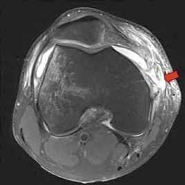 TT-jana kulkee samassa suunnassa patellajänteen tibiainsertion keskikohdalta. Siirtymä (punainen nuoli) mitataan millimetreinä. Esimerkkikuvassa siirtymä on 13 mm eli normaali mediaani.