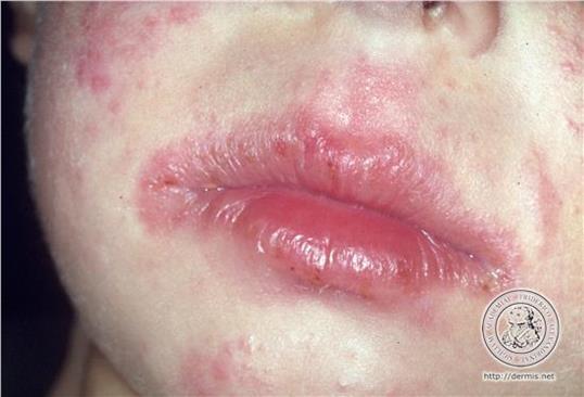 ihottuma Cheilitis