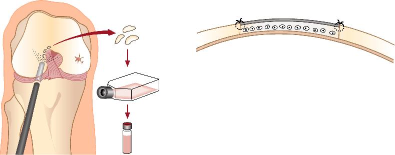 14 Lynch TS, Patel RM, Benedick A, Amin NH, Jones MH, Miniaci A. Systematic review of autogenous osteochondral transplant outcomes. Arthroscopy 2015;31:746 54. 15 Vanlauwe J, Saris DB, Victor J ym.