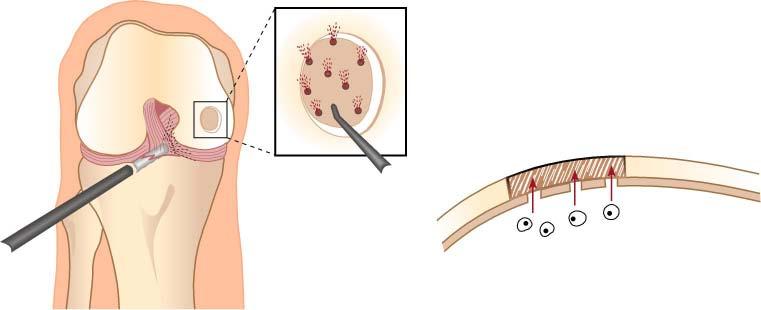 Kuva 2. Mikromurtumamenetelmässä rustovaurion pohja puhdistetaan ja rei itetään. Tällöin muodostuu kasvutekijöitä ja kantasoluja sisältävä verihyytymä, joka muodostaa arpirustoa (A).