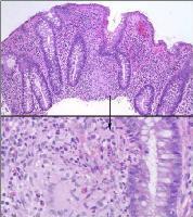 Colitis ulcerosa Colon Jatkuvat muutokset