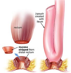 10 vuotta proktokolektomian jälkeen Kirurginen komplikaatio 75% Re-operaatio 54% Pouchitis ( pussiitti ) 73% ainakin 1