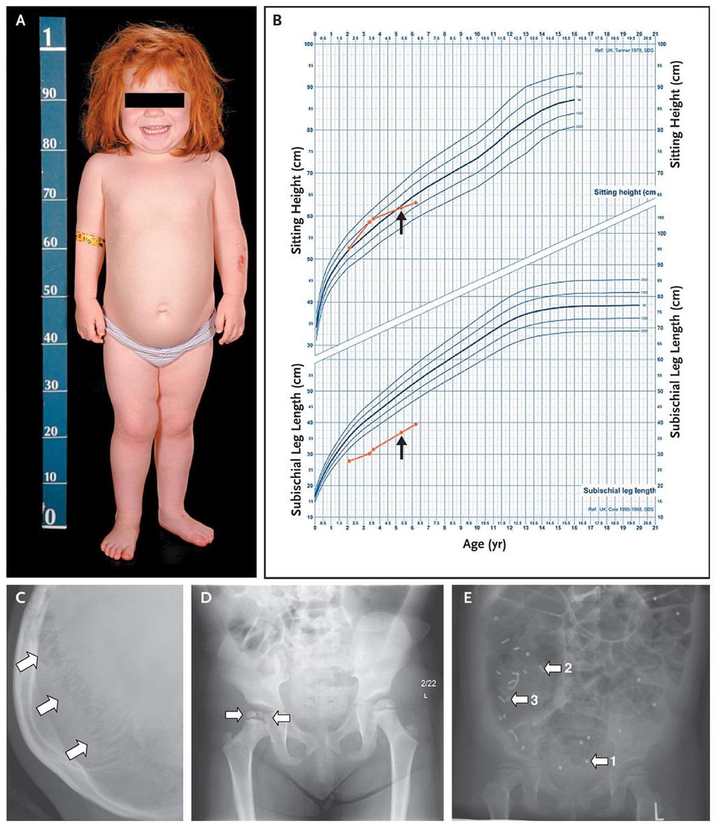 Phenotypic Features of the Patient with TRHa