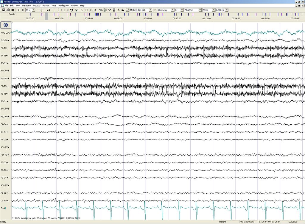 Päiv-EEG-ilmiöitä 8/17:
