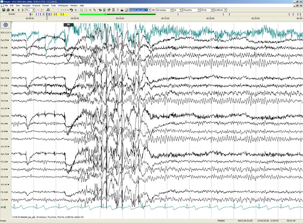 Päiv-EEG-ilmiöitä 3/17: