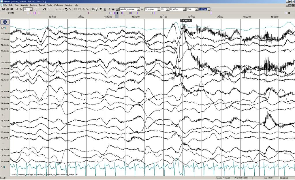 Päiv-EEG-ilmiöitä 5/17: