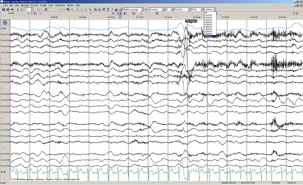 Päiv-EEG-ilmiöitä 6/17: Sama potilas,