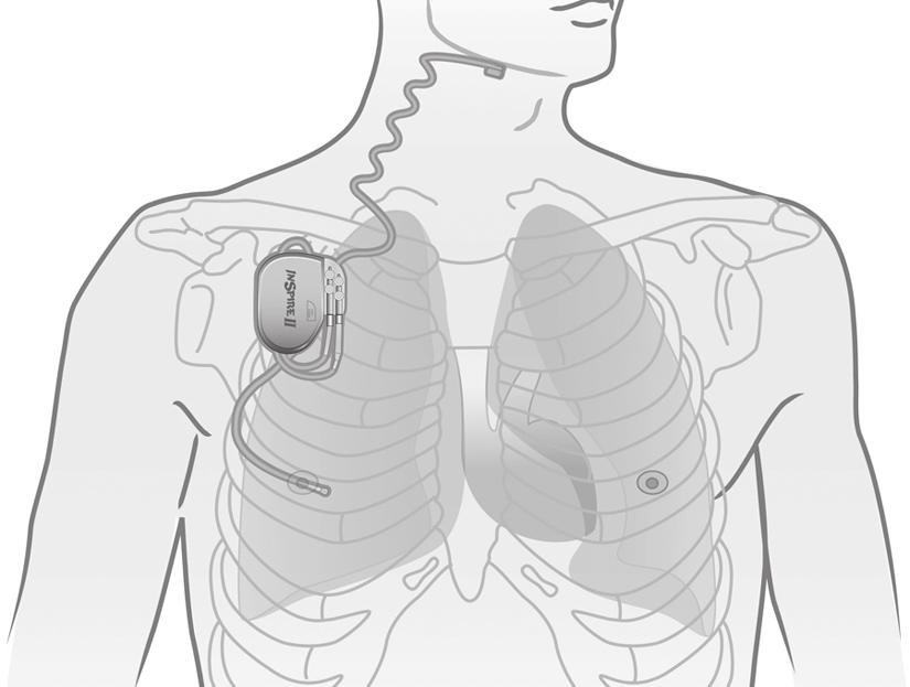 3. Ylähengitysteiden Inspirestimulaatiohoito Inspire-järjestelmä Stimulaatiojohto Stimulaattori Hengityksen tunnistinjohto Kuva 2.