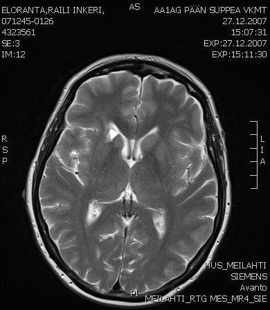 MRI