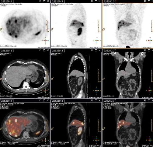 Potilaalla ohutsuolilähtöinen neuroendokriininen kasvain joka metastasoinut maksaan.