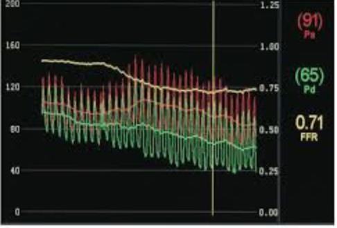 Painevaijerimittaus - Mitataan adenosiini-infuusion aikana - FFR