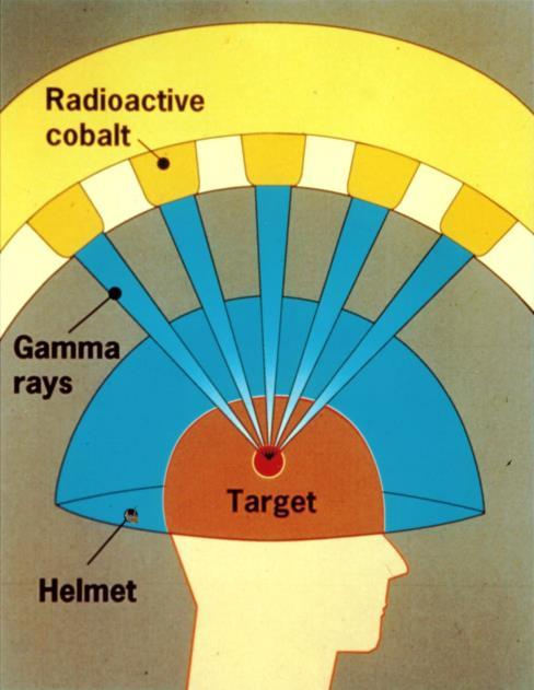 Esimerkki Gammaveitsi on radioneurokirurgiassa käytettävä laite, jossa esim.