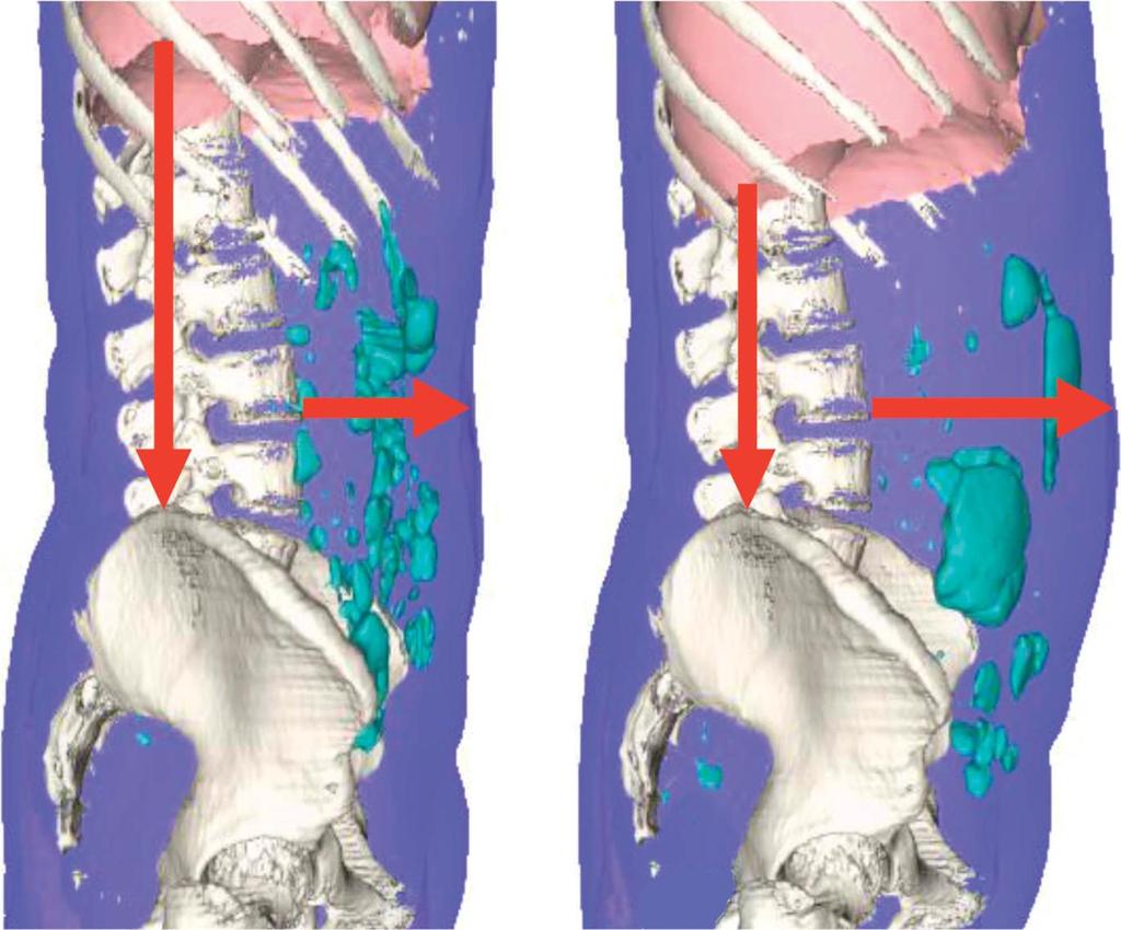 VATSAN TURVOTUS Abdominal imaging in a patient with functional bloating. The left panel CT image shows a non-distended period with a mild bloating sensation.