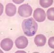 Therapiafennica.fi Malarian käytännön diagnostiikka 1. Onko malaria? 2. Mikä laji? vaikuttaa hoitoon: P.