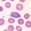 parasitemian aste ei suoraan korreloi taudin vaikeuteen falciparum-malaria voi olla tappava, vaikka parasitemia-aste olisi alle 0.