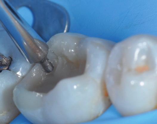 Instrumentin haarukkamainen kärki muotoilee reunaharjun matriisin yli kopioiden naapurihampaan korkeuden ja anatomian.