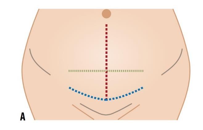 9 vain syvennetään, jotta leikkaus voidaan suorittaa. Epiduraalipuudutus on myös hemodynaamisilta vaikutuksiltaan pehmeämpi ja soveliaampi. (Paananen ym. 2017.