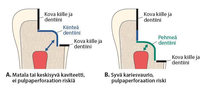 Paikan valmistaminen: kaviteetin preparointi ja muotoilu Kun hammasta preparoidaan paikkausta varten, vaurion laajuus määrää preparointitarpeen.