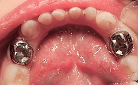 Lasten hampaiden paikkaushoito Maitohampaistossa etualueen paikkausmateriaalina voidaan käyttää kaviteetin laajuuden mukaan lasi-ionomeeria, kompomeeriä tai yhdistelmämuovia.