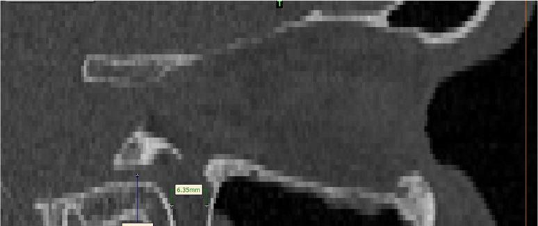 Pterygomaxillary fissure (PMF) PMF