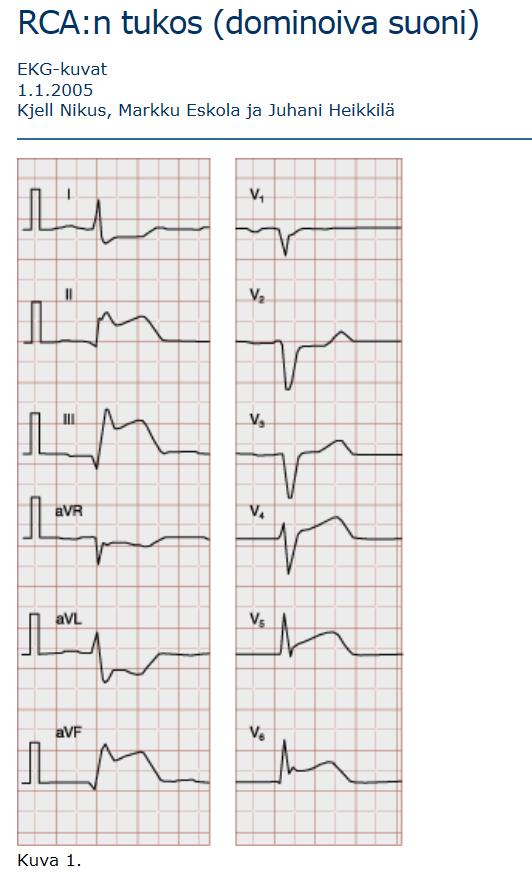 STEMI 17.