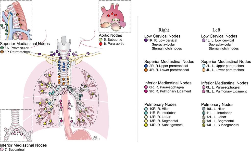 Figure 1 Illustration shows the IASLC lymph node map. L. = left, R. = right. RadioGraphics, http://pubs.rsna.org/doi/abs/10.1148/rg.346130097 Published in: Ahmed H. El-Sherief; Charles T.