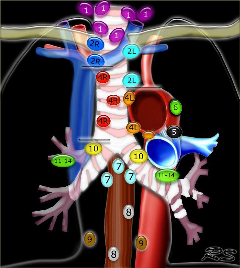 1. Low cervical, supraclavicular and sternal notch nodes 2R.Upper Paratracheal 2L.Upper Paratracheal 3A.